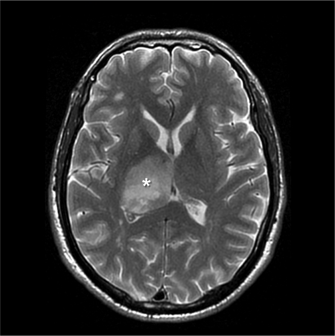 axial T2 MRI