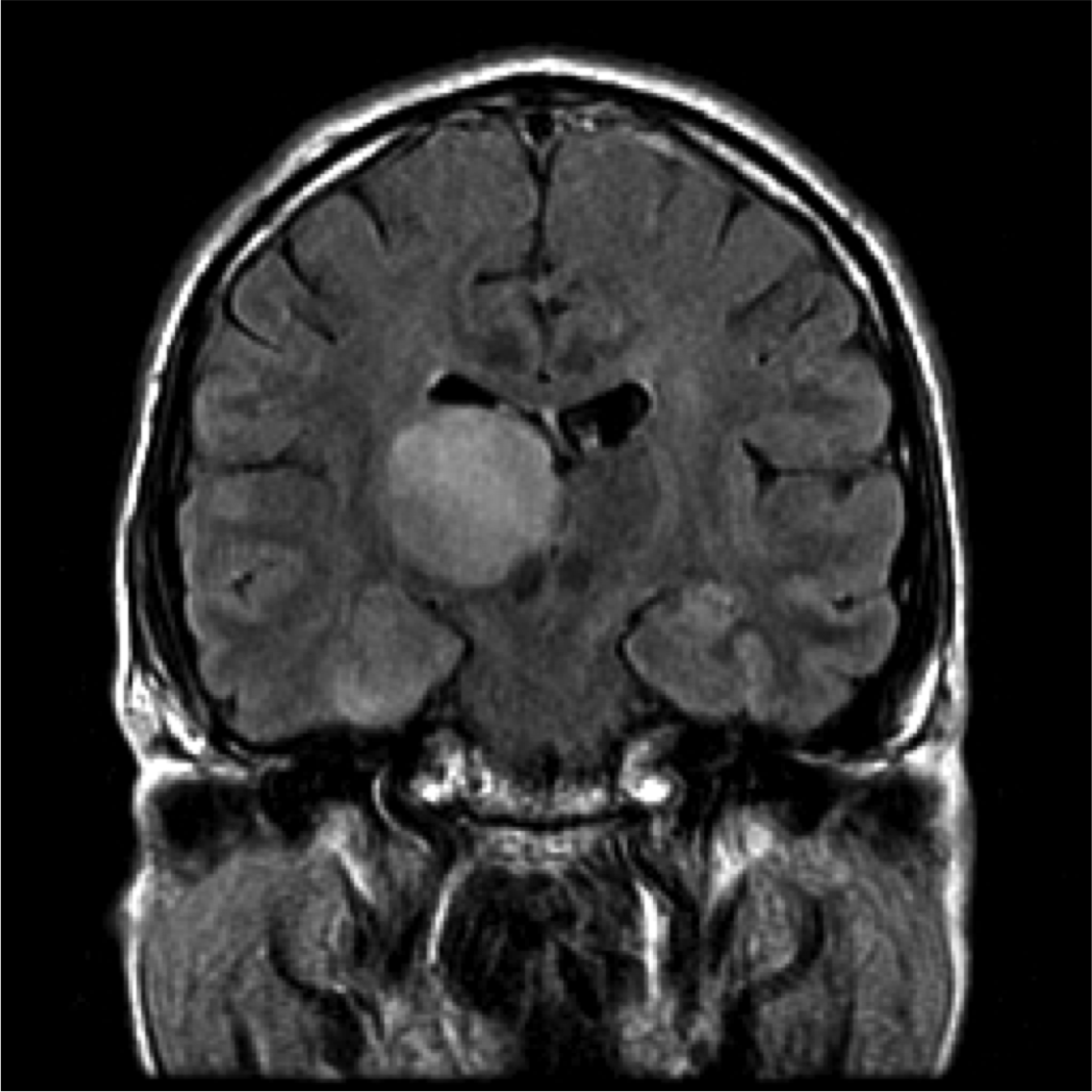 coronal FLAIR MRI