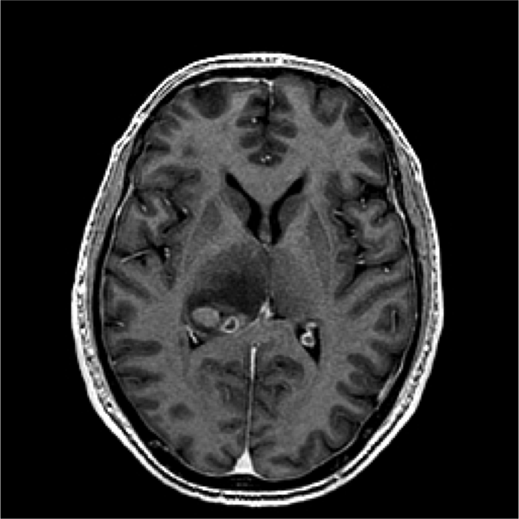 axial T1 MRI + contrast