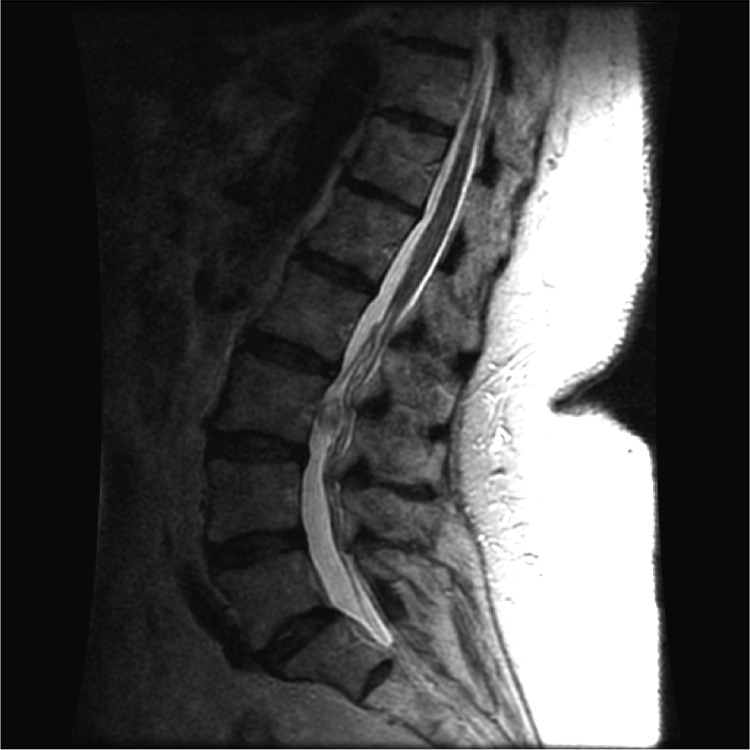 sagittal T2 MRI