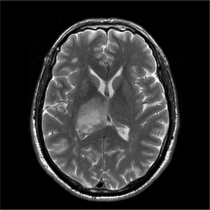 axial T2 MRI