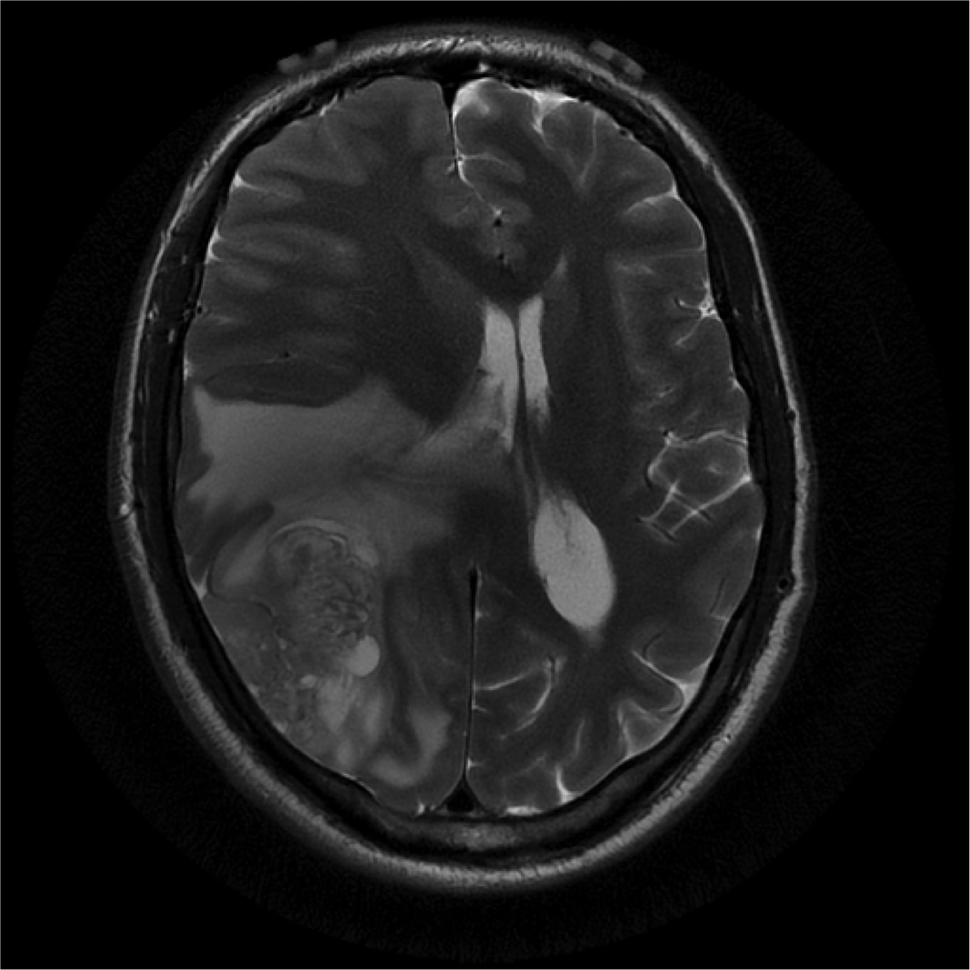 MRI, axial, T2-weighted