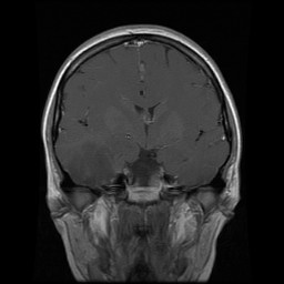 coronal T1 MRI + contrast