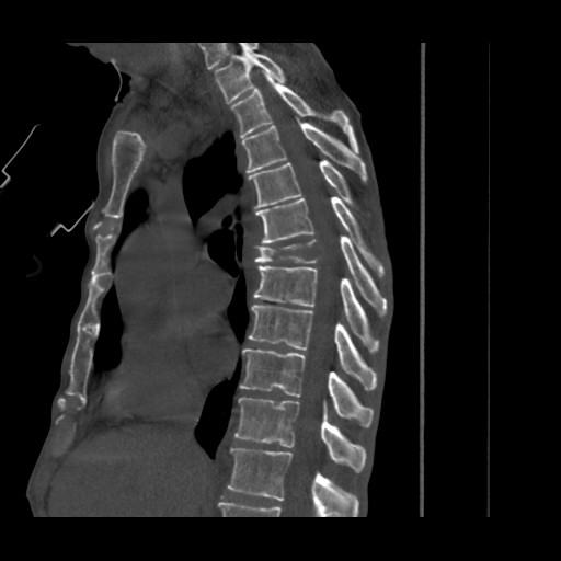 sagittal CT reformat