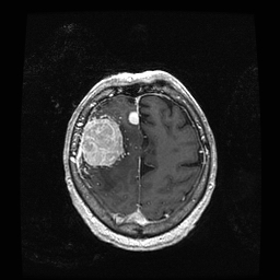 axial T1 MRI + contrast