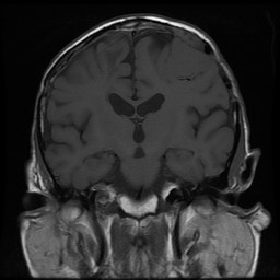 coronal T1 MRI