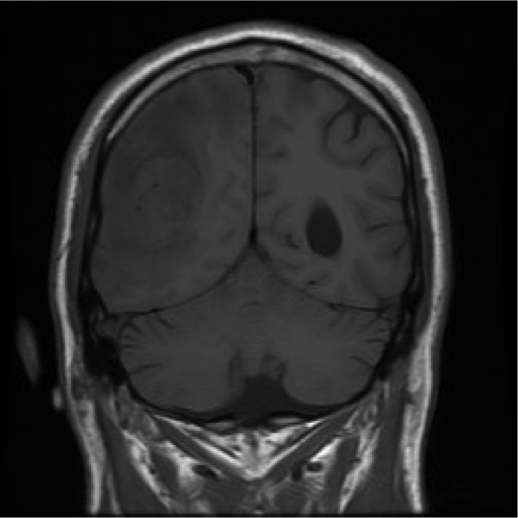 coronal T1 MRI