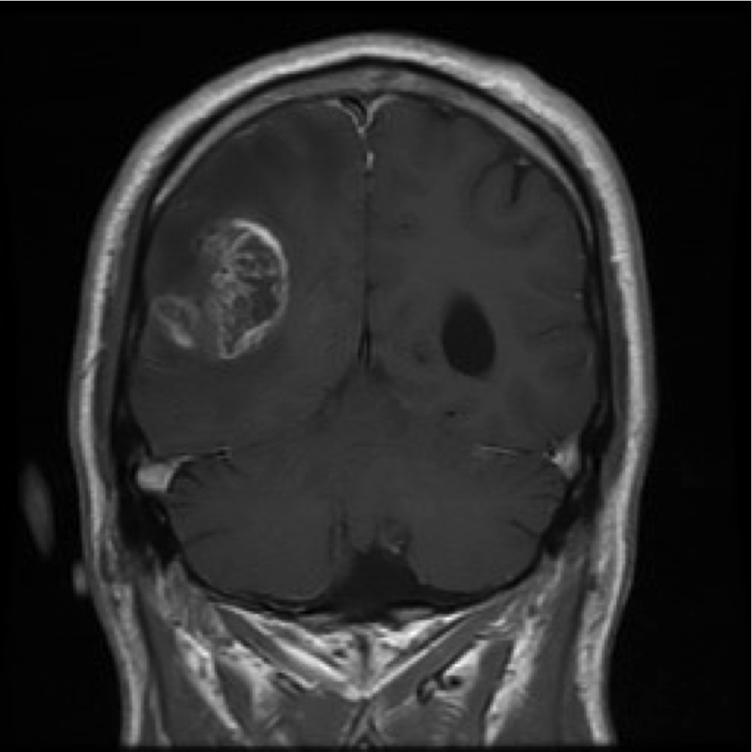 coronal T1 MRI + contrast